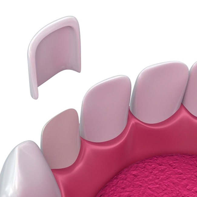 Diagram showing how veneers in Van Nuys work