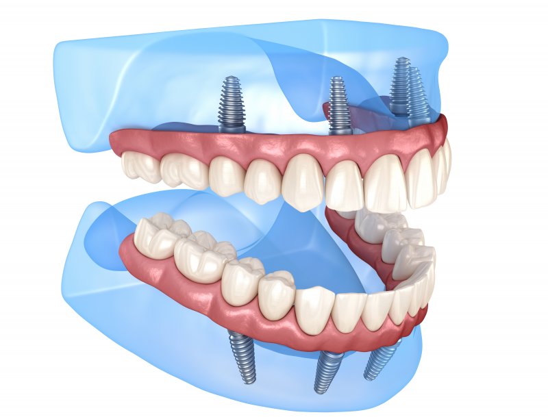 Illustration of dentures supported by dental implants